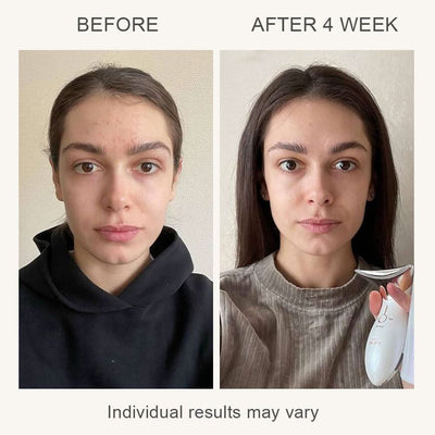 SonoDerm LuminaLift™