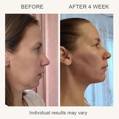 SonoDerm LuminaLift™