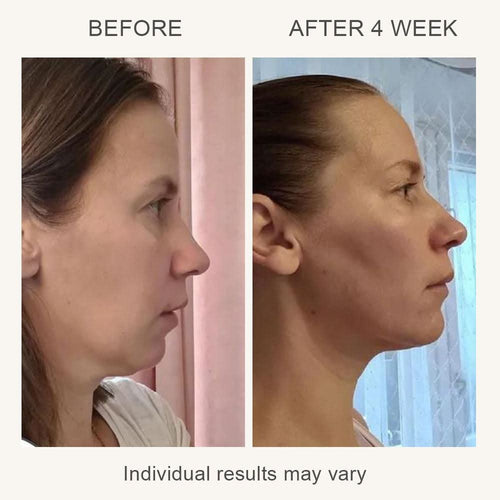 SonoDerm LuminaLift™