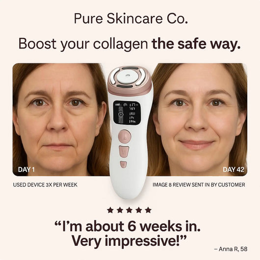 SonoDerm TriLift Elite - 3-in-1 RF+EMS+HIFU Face & Body Tightening System